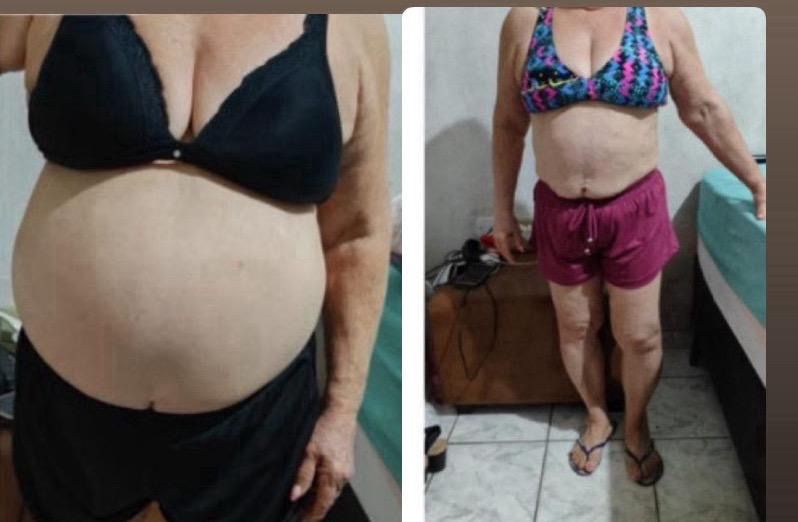 Antes e depois de aluna da comunidade, de frente, mostrando a redução do volume da barriga